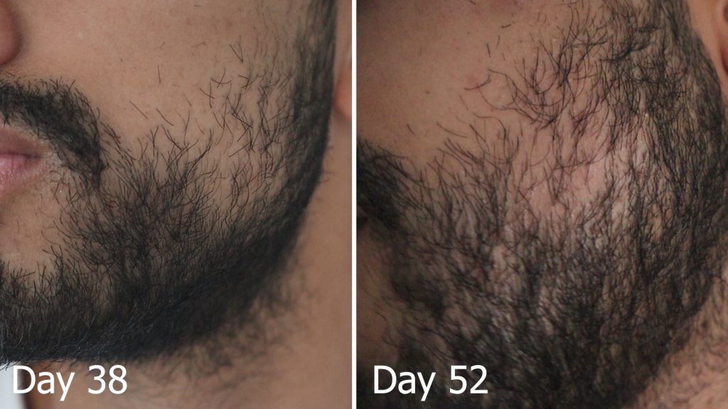 My progress pictures using the beard growth kit - CPH Grooming results